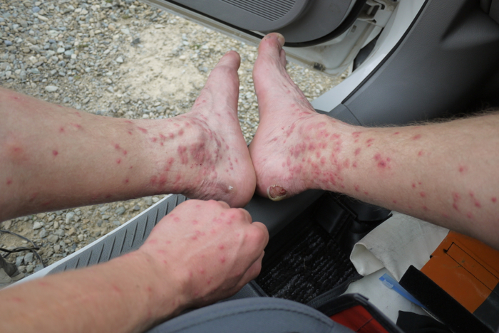 Scars of days of sandfly attacks and hiking Scars of days of sandfly attacks and hiking