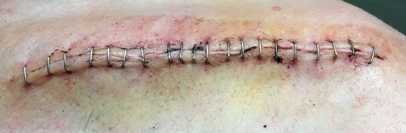 Selon le chirurgien, une suture à l’agrafe cicatrise mieux… Selon le chirurgien, une suture à l’agrafe cicatrise mieux…