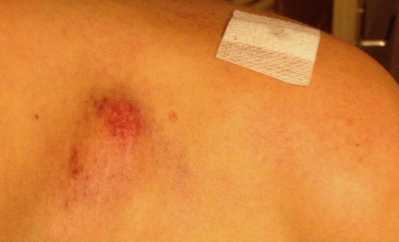 Quand le bout de clavicule cassé te donne quand même un peu l’impression qu’il veut percer ton épaule Quand le bout de clavicule cassé te donne quand même un peu l’impression qu’il veut percer ton épaule