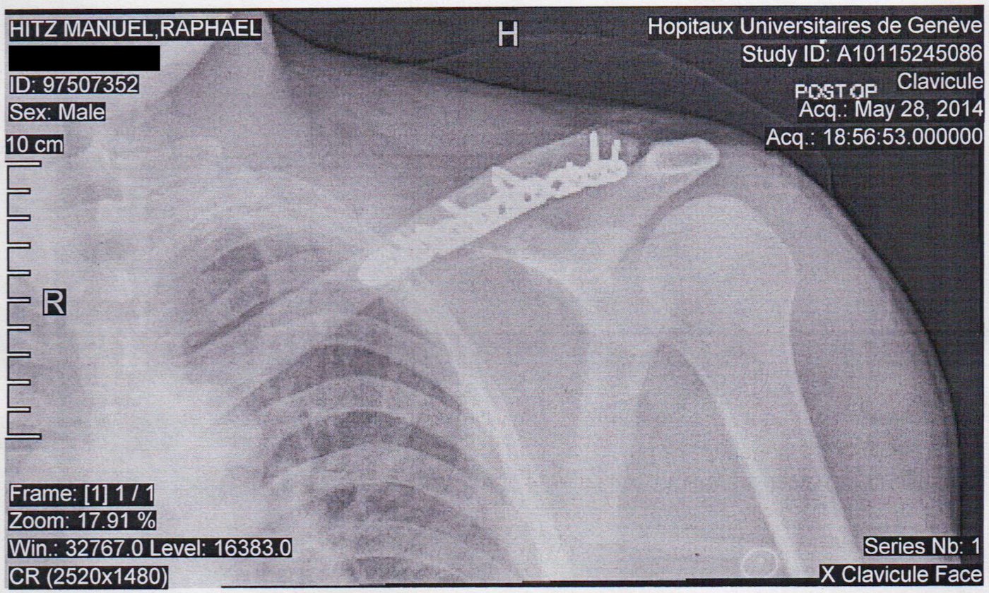 Radio post-op Radio post-op