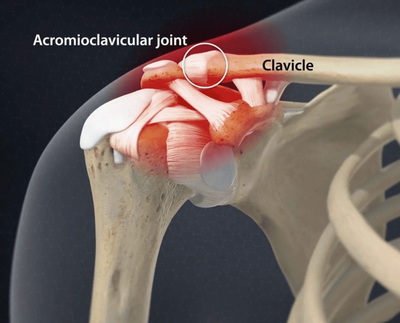 Le ligament acromio-claviculaire relie l’os de la clavicule à l’acromion, une partie de l’omoplate. Une luxation de stade 2 signifie une déchirure partielle ou une élongation de ce ligament Le ligament acromio-claviculaire relie l’os de la clavicule à l’acromion, une partie de l’omoplate. Une luxation de stade 2 signifie une déchirure partielle ou une élongation de ce ligament