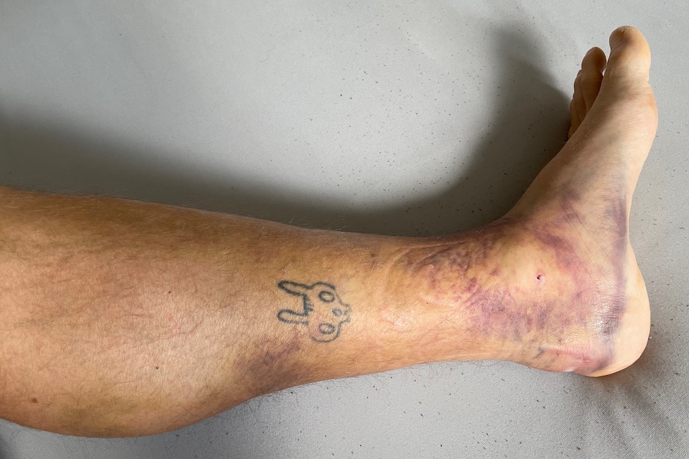 For my birthday I got a pretty hardcore muscle bruise For my birthday I got a pretty hardcore muscle bruise