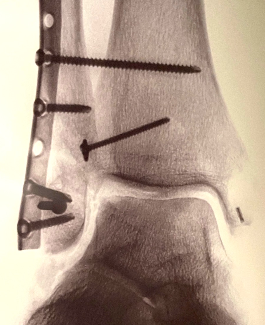 Broken ankle Broken ankle